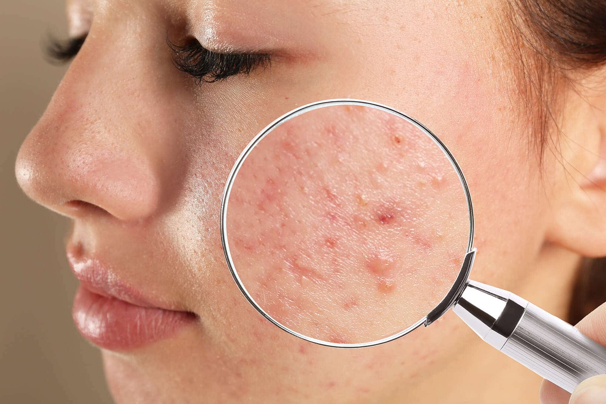 Acne Scar Treatment at Sinta Medical Center in Dubai