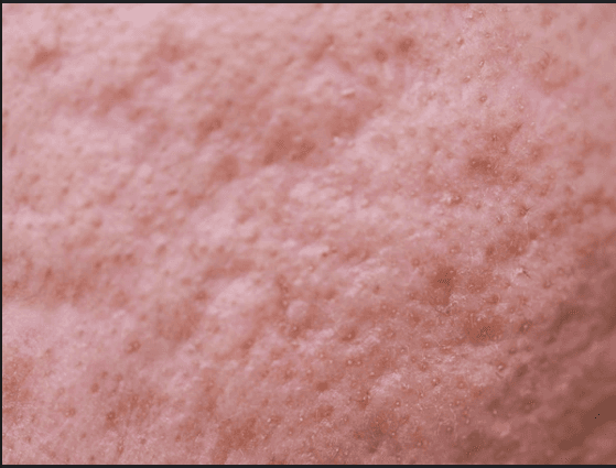 Image of Boxcar Acne Scars