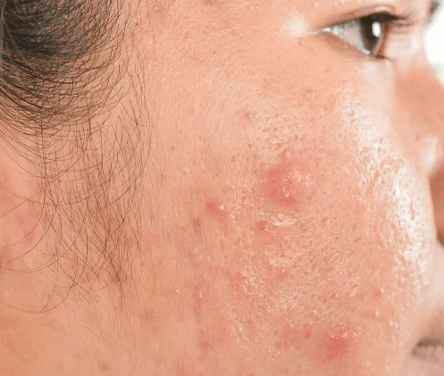 Image of Hypertrophic Acne Scars
