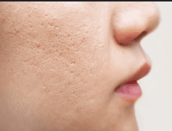 Image of Ice Pick Acne Scars