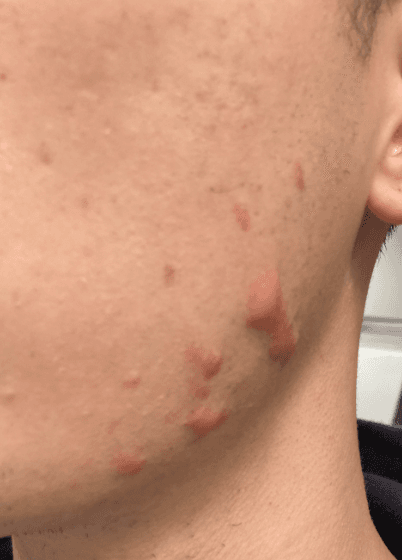 Image of Keloid Acne Scars