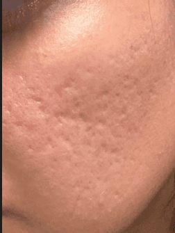Image of Rolling Acne Scars